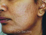 laser resurfacing acne scarring after (180)